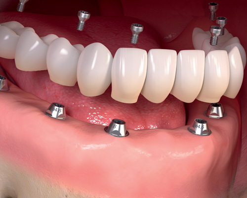 Full Mouth Dental Implant 70