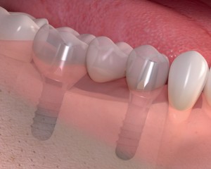 Multiple-Dental-Implants