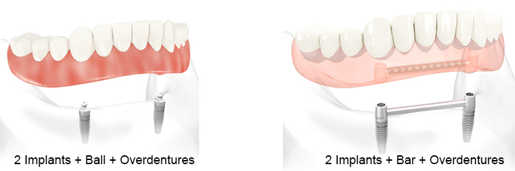 2 Implants Overdentures