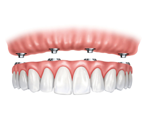 4 Implants + Fixed Bridge