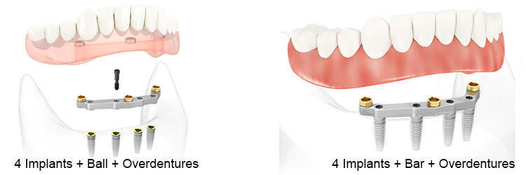 4 Implants Overdentures