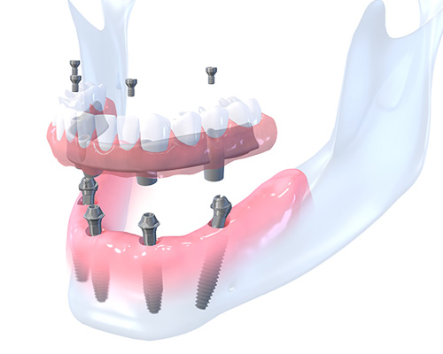 All-on-4 Immediate Function Dental Implants