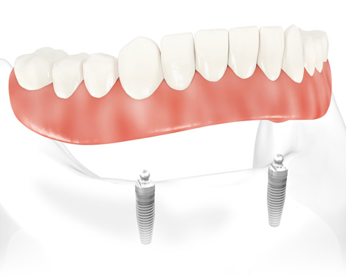 Implant Supported Overdentures Procedures 4