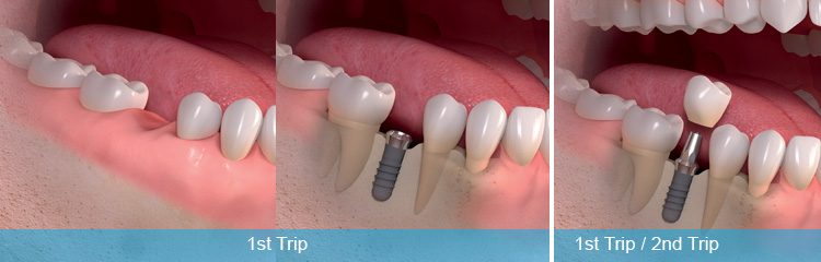 Can Dental Implants Be Done in One Day?