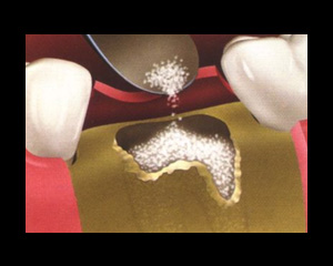 Bone Graft