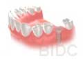 dental-implant-step-4