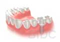 dental-implant-step-5