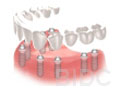 implant-bridge-step-4