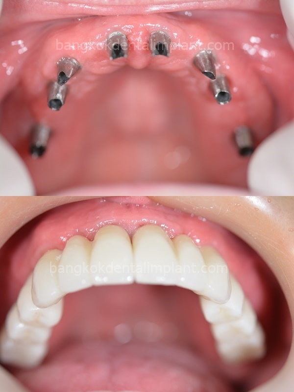 Dental Implant Cases