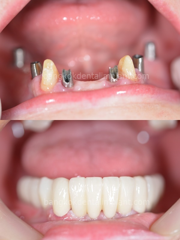Dental Implant Cases