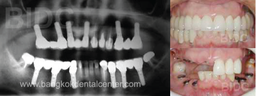 Full-Mouth-Dental-Implants-with-Fixed-Bridges