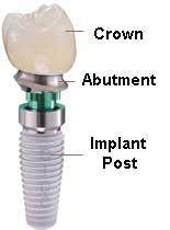 dental-implant-parts