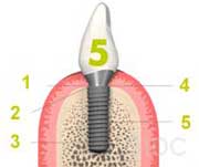 straumann-bone-level