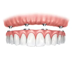 Implants Fixed Bridge