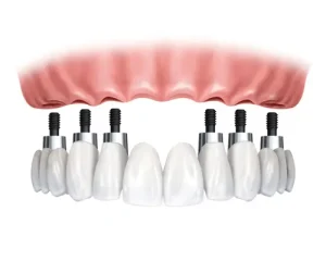 Implants Fixed Bridge