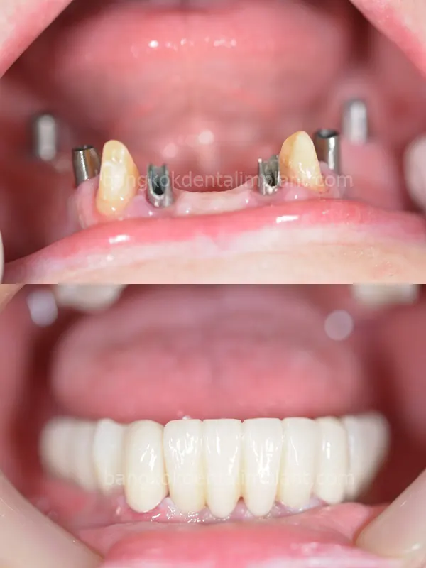 Dental Implant