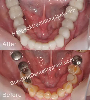 Dental Implant