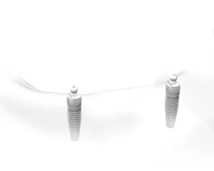 Implant Supported Overdentures Procedures