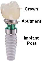 Dental Implant Parts