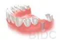 Dental Implant step 3