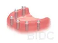 implant bridge