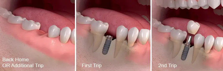 standard dental implant